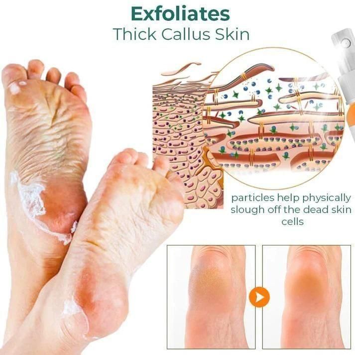 Foot Callus Removal Spray(Pack Of 2) - PURE